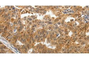 Immunohistochemistry of paraffin-embedded Human ovarian cancer tissue using SOCS7 Polyclonal Antibody at dilution 1:30 (SOCS7 Antikörper)