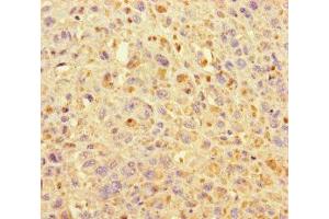 Immunohistochemistry of paraffin-embedded human melanoma using ABIN7157632 at dilution of 1:100