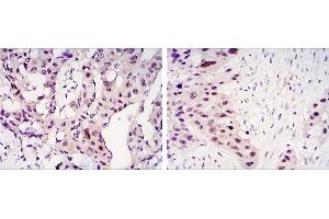 Immunohistochemical analysis of paraffin-embedded mammary cancer tissues (left) and lung cancer tissues (right) using STAT3 mouse mAb with DAB staining. (STAT3 Antikörper)