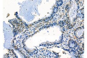 ABIN6258550 and ABIN6275237 at 1/100 staining Human ovarian cancer by IHC-P.