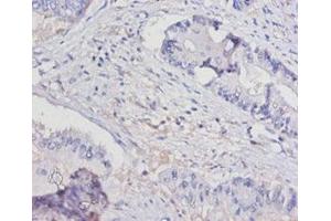 Immunohistochemistry of paraffin-embedded human colon cancer using ABIN7156799 at dilution of 1:100