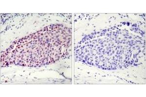 Immunohistochemistry analysis of paraffin-embedded human breast carcinoma tissue, using ATF2 (Ab-112 or 94) Antibody. (ATF2 Antikörper  (AA 79-128))