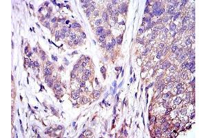 Immunohistochemical analysis of paraffin-embedded bladder cancer tissues using MAPK3 mouse mAb with DAB staining.