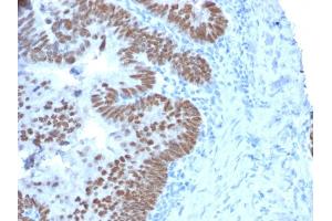 Formalin-fixed, paraffin-embedded human Colon Carcinoma stained with CDX2 Mouse Monoclonal Antibody (CDX2/2214). (CDX2 Antikörper)