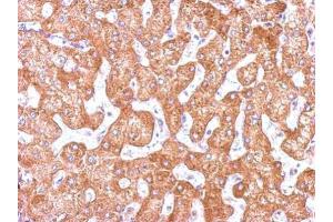 IHC-P Image Immunohistochemical analysis of paraffin-embedded human hepatoma, using GCP2, antibody at 1:500 dilution. (TUBGCP2 Antikörper  (N-Term))