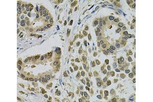 Immunohistochemistry of paraffin-embedded Human breast cancer using EBAG9 Polyclonal Antibody at dilution of 1:100 (40x lens). (RCAS1 Antikörper)