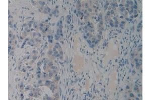 Detection of PACAP in Human Breast cancer Tissue using Polyclonal Antibody to Pituitary Adenylate Cyclase Activating Peptide (PACAP) (Pituitary Adenylate Cyclase Activating Peptide (AA 17-176) Antikörper)