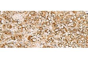 Immunohistochemistry of paraffin-embedded Human liver cancer tissue using MTAP Polyclonal Antibody at dilution of 1:70(x200) (MTAP Antikörper)