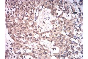 Immunohistochemical analysis of paraffin-embedded esophageal cancer tissues using ASH2L mouse mAb with DAB staining. (ASH2L Antikörper  (AA 493-628))