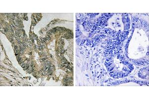 Peptide - +Immunohistochemistry analysis of paraffin-embedded human colon carcinoma tissue using ALDOC antibody. (ALDOC Antikörper  (Internal Region))