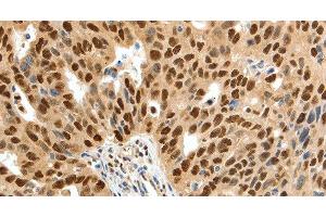 Immunohistochemistry of paraffin-embedded Human ovarian cancer tissue using SSB Polyclonal Antibody at dilution 1:50 (SSB Antikörper)