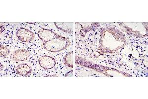 Immunohistochemical analysis of paraffin-embedded gastric cancer tissues (left) and lung cancer tissues (right) using CDH1 mouse mAb with DAB staining. (E-cadherin Antikörper)