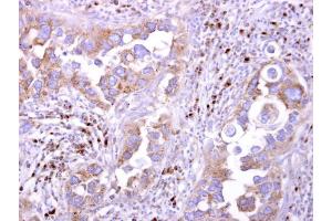 IHC-P Image LILRB5 antibody [N2C1], Internal detects LILRB5 protein at cytosol on human breast carcinoma by immunohistochemical analysis. (LILRB5 Antikörper  (Internal Region))