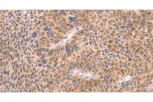 Immunohistochemistry of paraffin-embedded Human liver cancer using AASDHPPT Polyclonal Antibody at dilution of 1:30 (AASDHPPT Antikörper)