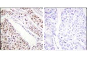 Immunohistochemistry analysis of paraffin-embedded human lung carcinoma tissue, using Histone H2B (Acetyl-Lys12) Antibody. (Histone H2B Antikörper  (acLys12))