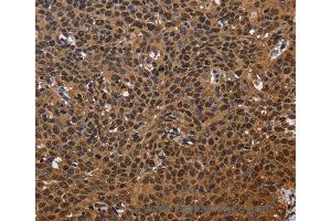 Immunohistochemistry of Human colon cancer using EXTL3 Polyclonal Antibody at dilution of 1:50