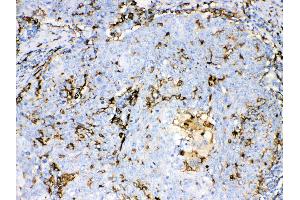 Iba1 was detected in paraffin-embedded sections of human lung cancer tissues using rabbit anti- Iba1 Antigen Affinity purified polyclonal antibody (Catalog # ) at 1 µg/mL. (Iba1 Antikörper  (C-Term))