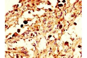 IHC image of ABIN7161390 diluted at 1:300 and staining in paraffin-embedded human melanoma performed on a Leica BondTM system. (NPAS4 Antikörper  (AA 445-585))