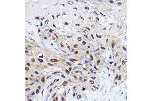 Immunohistochemistry of paraffin-embedded human esophageal cancer using SM Rabbit pAb (ABIN6132562, ABIN6148098, ABIN6148099 and ABIN6214424) at dilution of 1:100 (40x lens). (SMARCA1 Antikörper  (AA 1-200))