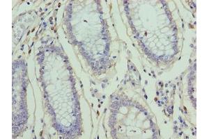Immunohistochemistry of paraffin-embedded human colon cancer using ABIN7176373 at dilution of 1:100 (ZNF555 Antikörper  (AA 1-200))