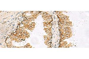Immunohistochemistry of paraffin-embedded Human prost at e cancer tissue using SH3YL1 Polyclonal Antibody at dilution of 1:55(x200) (SH3YL1 Antikörper)