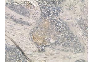 ABIN6257231 and ABIN6273685 at 1/100 staining human breast carcinoma by IHC-P.