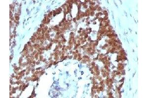 IHC testing of FFPE human ovarian carcinoma with Nucleolin antibody (clone NPC23-2). (Nucleolin Antikörper)