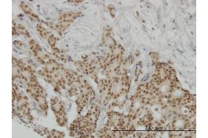 Immunoperoxidase of monoclonal antibody to PGR on formalin-fixed paraffin-embedded human breast cancer. (Progesterone Receptor Antikörper  (AA 1-110))