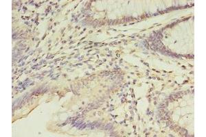 Immunohistochemistry of paraffin-embedded human colon cancer using ABIN7152867 at dilution of 1:100 (FGL2 Antikörper  (AA 24-439))