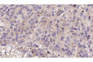 ABIN6273207 at 1/100 staining Human melanoma tissue by IHC-P. (CFHR3 Antikörper)