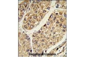 Formalin-fixed and paraffin-embedded human hepatocarcinoma reacted with CSGALNACT2 Antibody (Center), which was peroxidase-conjugated to the secondary antibody, followed by DAB staining. (CSGALNACT2 Antikörper  (AA 200-229))