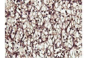 Immunohistochemical staining of paraffin-embedded Carcinoma of Human kidney tissue using anti-IDS mouse monoclonal antibody. (IDS Antikörper)