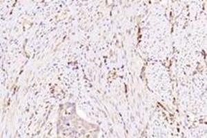 Immunohistochemistry analysis of paraffin-embedded human cervical cancer using NXF2 (ABIN7074901) at dilution of 1: 3000