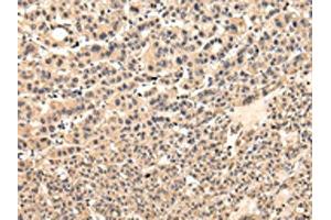 The image on the left is immunohistochemistry of paraffin-embedded Human liver cancer tissue using ABIN7131585(VPS37D Antibody) at dilution 1/30, on the right is treated with fusion protein. (VPS37D Antikörper)