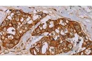 Immunohistochemistry of paraffin-embedded Human breast cancer tissue using MTUS1 Polyclonal Antibody at dilution 1:40