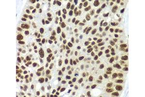 Immunohistochemistry of paraffin-embedded Human lung cancer using SF3B2 Polyclonal Antibody at dilution of 1:100 (40x lens). (SF3B2 Antikörper)