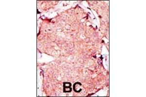 Formalin-fixed and paraffin-embedded human cancer tissue reacted with the primary antibody, which was peroxidase-conjugated to the secondary antibody, followed by AEC staining. (Adenylate Kinase 3 Antikörper  (C-Term))