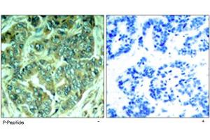 Immunohistochemical analysis of paraffin-embedded human breast carcinoma tissue using DOK1 (phospho Y398) polyclonal antibody . (DOK1 Antikörper  (pTyr398))
