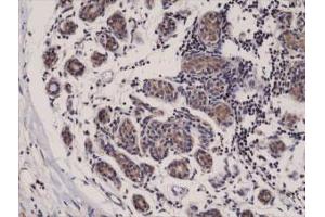 Immunohistochemical staining (Formalin-fixed paraffin-embedded sections) of human breast cancer with DIABLO monoclonal antibody, clone RM271 . (DIABLO Antikörper  (C-Term))