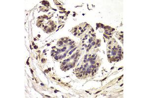 Immunohistochemistry of paraffin-embedded Human mammary cancer using INTS6 antibody at dilution of 1:100 (x400 lens). (INTS6 Antikörper)