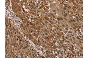 The image on the left is immunohistochemistry of paraffin-embedded Human lung cancer tissue using ABIN7192693(STMN2/STMN3/STMN4 Antibody) at dilution 1/45, on the right is treated with synthetic peptide. (STMN2/STMN3/STMN4 Antikörper)