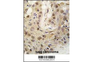 Formalin-fixed and paraffin-embedded human lung carcinoma tissue reacted with cGKII antibody , which was peroxidase-conjugated to the secondary antibody, followed by DAB staining. (PRKG2 Antikörper  (C-Term))