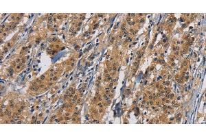 Immunohistochemistry of paraffin-embedded Human gastric cancer tissue using PIKFYVE Polyclonal Antibody at dilution 1:50 (PIKFYVE Antikörper)