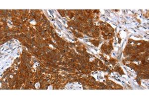 Immunohistochemistry of paraffin-embedded Human cervical cancer tissue using HOXB1 Polyclonal Antibody at dilution 1:40 (HOXB1 Antikörper)