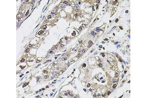 Immunohistochemistry of paraffin-embedded Human gastric cancer using CA9 Polyclonal Antibody at dilution of 1:100 (40x lens). (CA9 Antikörper)