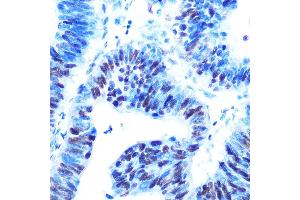 Immunohistochemistry of paraffin-embedded human colon carcinoma using USP7/HAUSP Rabbit mAb (ABIN7271168) at dilution of 1:100 (40x lens). (USP7 Antikörper)