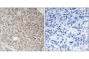 Immunohistochemistry analysis of paraffin-embedded human prostate carcinoma tissue, using AMOTL1 Antibody. (AMOTL1 Antikörper  (AA 441-490))