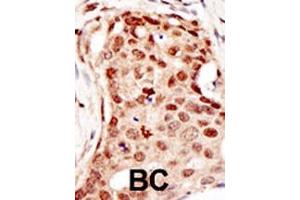 Formalin-fixed and paraffin-embedded human cancer tissue reacted with the primary antibody, which was peroxidase-conjugated to the secondary antibody, followed by DAB staining. (CBLC Antikörper  (C-Term))