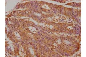 Immunohistochemical of paraffin-embedded human colon cancer using ABIN7173328 at dilution of 1:50 (TFF3 Antikörper)