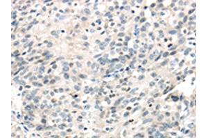 The image on the left is immunohistochemistry of paraffin-embedded Human ovarian cancer tissue using ABIN7191116(IQGAP2 Antibody) at dilution 1/40, on the right is treated with synthetic peptide. (IQGAP2 Antikörper)